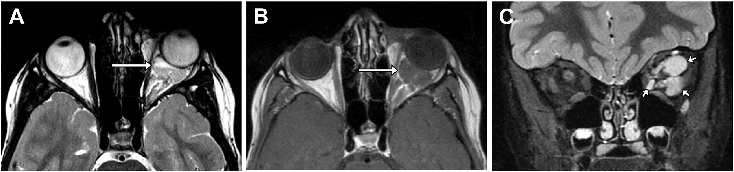 A three-panel magnetic resonance scan shows an orbital lymphatic malformation in the left intraconal space, highlighting intralesional hemorrhage and a multi-lobulated structure.