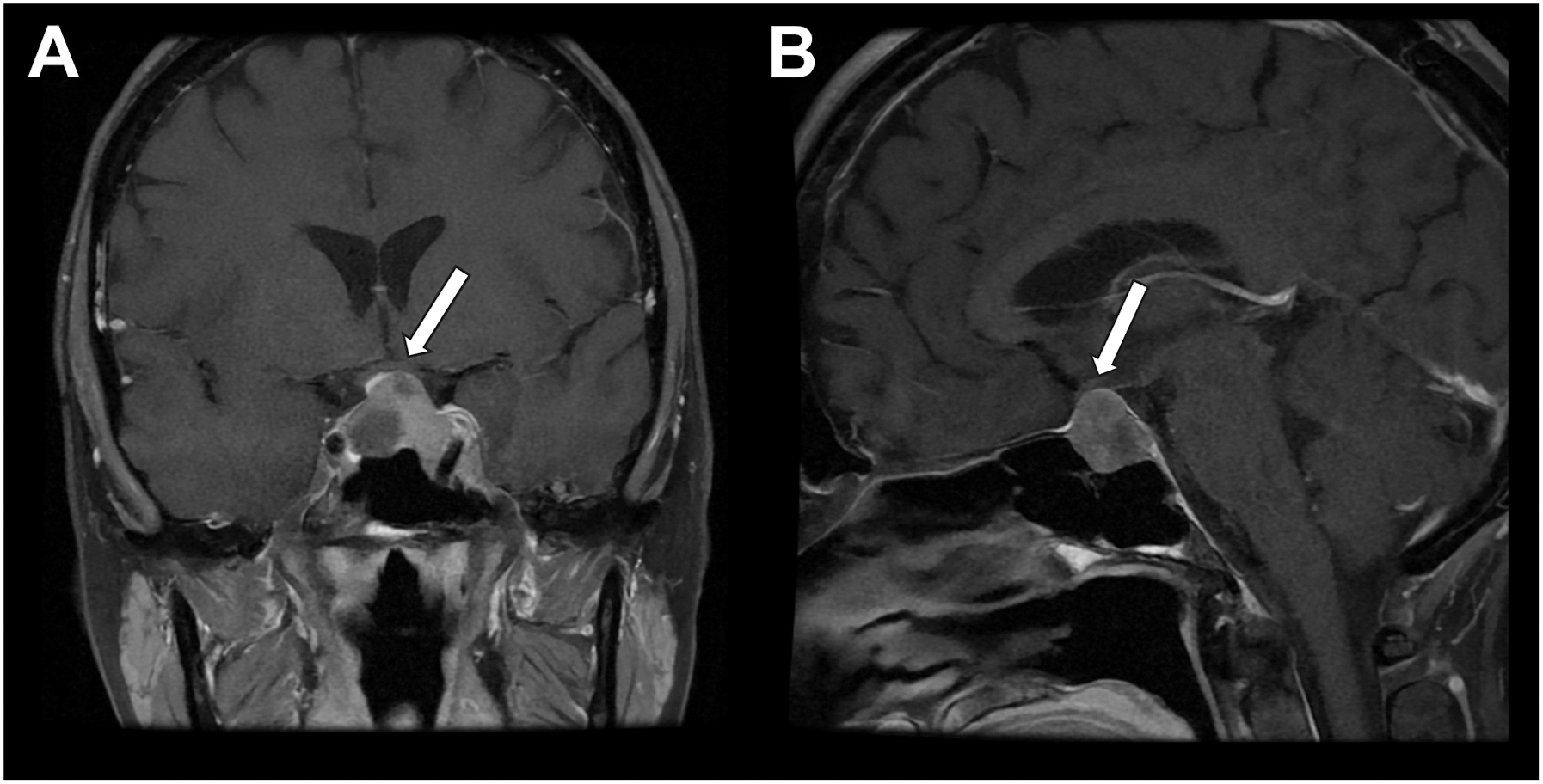A coronal and sagittal brain magnetic resonance imaging scan shows a pituitary macroadenoma that compresses the optic chiasm, highlighted by arrows.