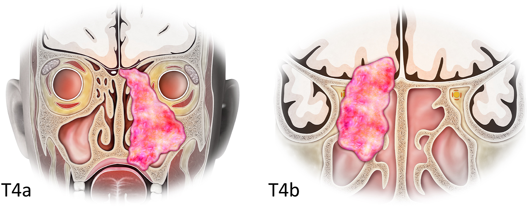 A labeled diagram shows T 4 a and T 4 b stage maxillary sinus tumors with extensive local invasion.