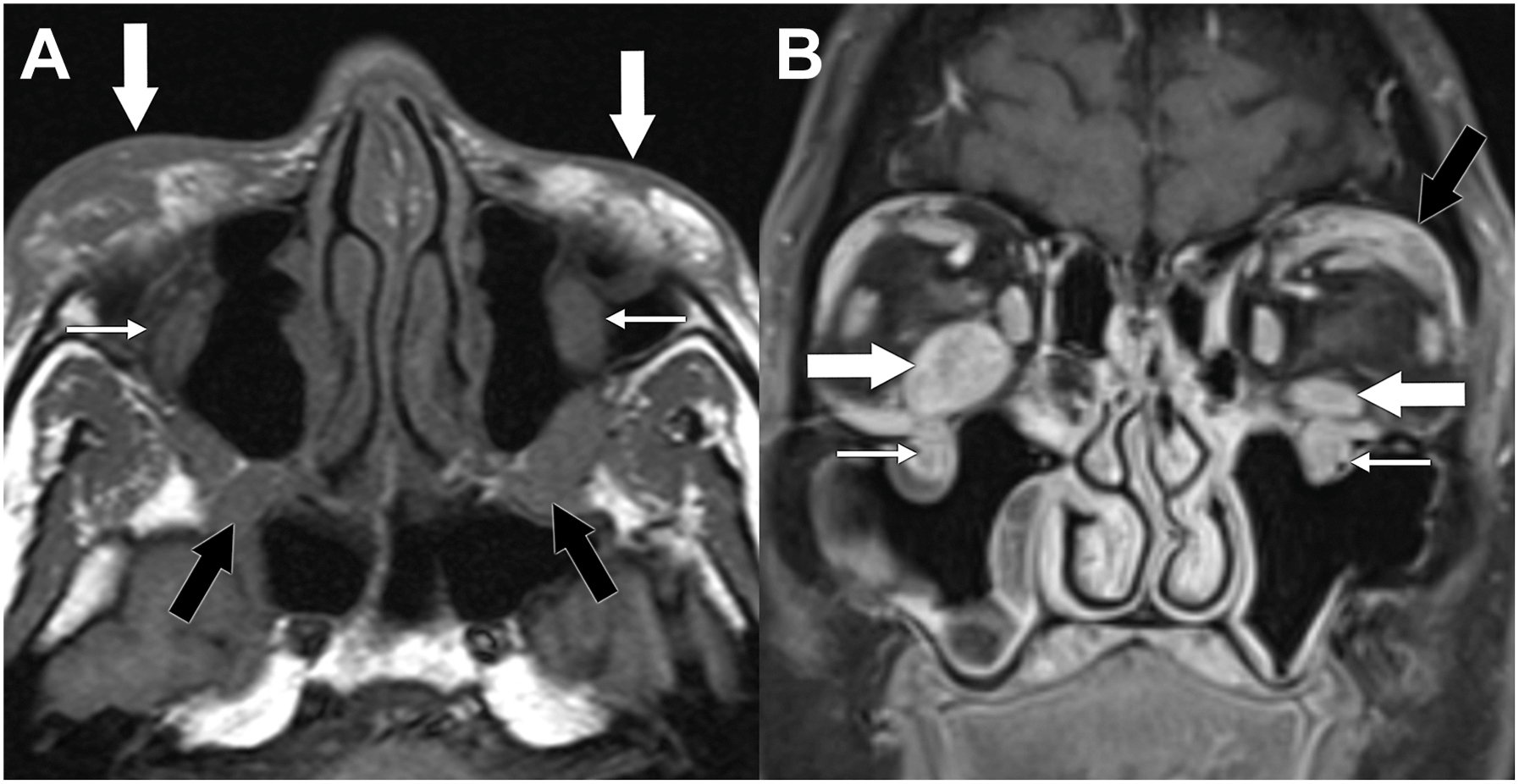 A two-part magnetic resonance imaging scan shows an idiopathic orbital inflammation, with arrows pointing to multifocal infiltrative disease in various facial and orbital soft tissues and nerves.