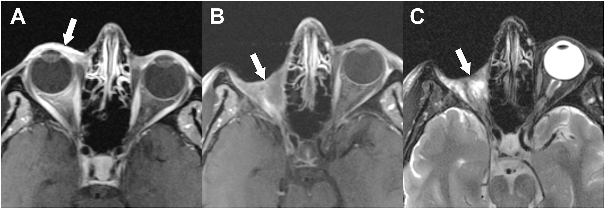 A set of three magnetic resonance imaging scans shows an enhancing eyelid lesion before surgery and the right orbit following an exenteration with a fasciocutaneous flap reconstruction.