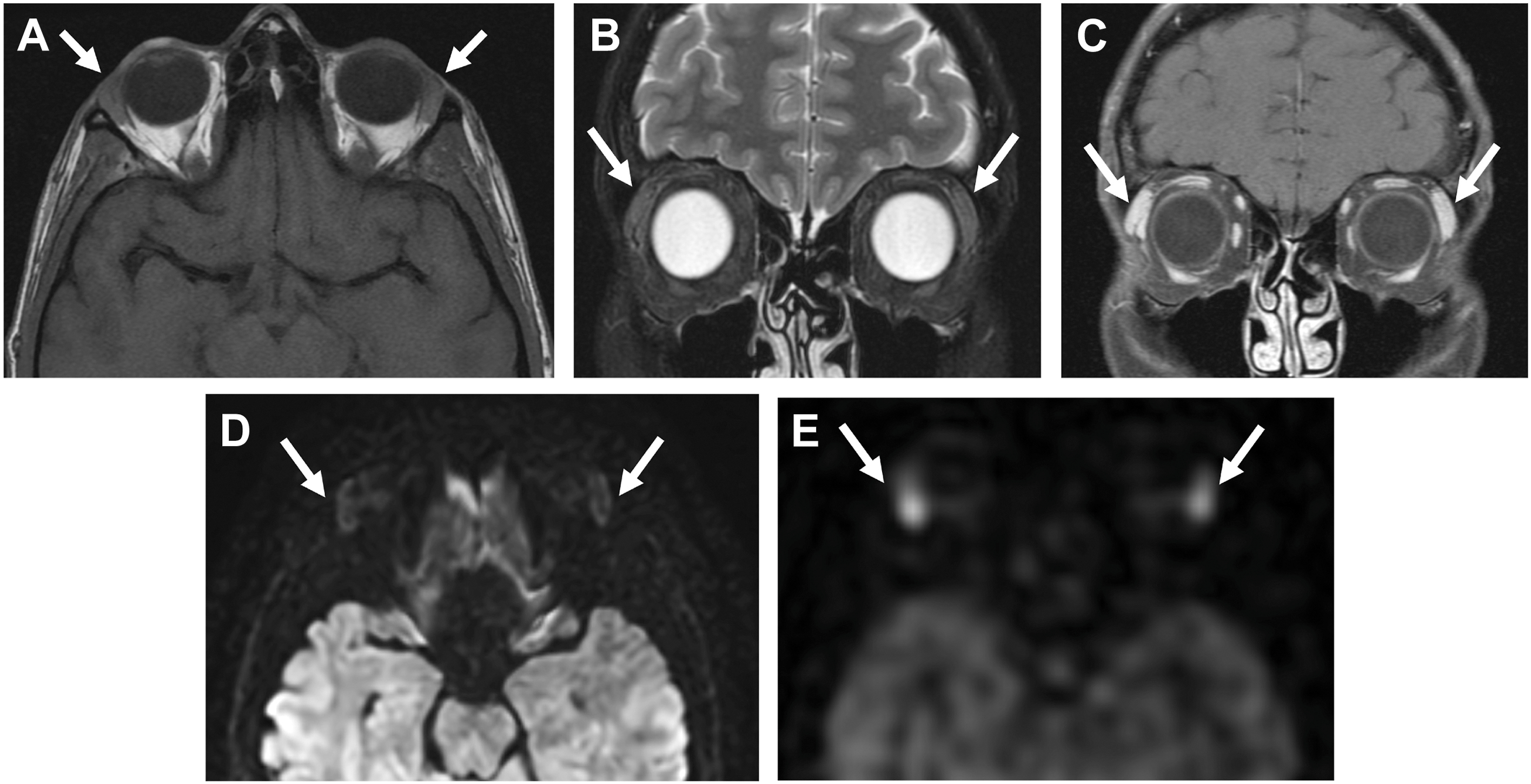 A five-part magnetic resonance image shows normal lacrimal glands, indicated by solid arrows across the panels, demonstrating different signal intensities, diffusion, and elevated perfusion.