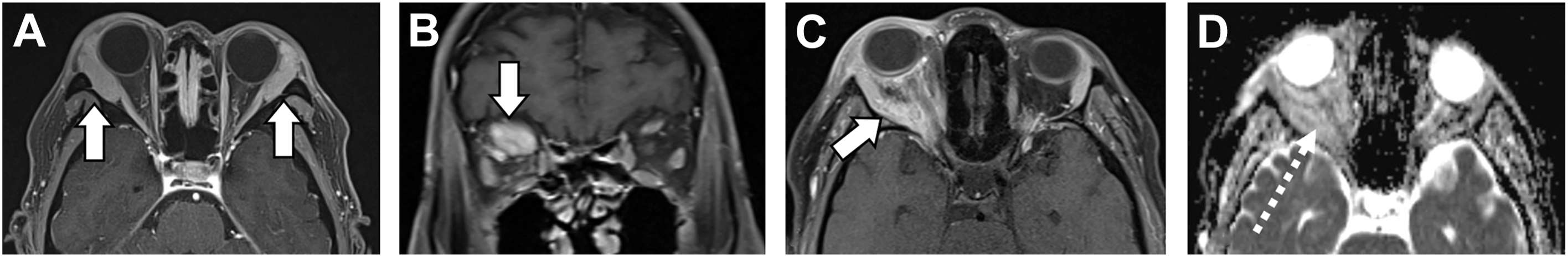 Four M R I scans labeled A through D illustrate different cases of eye socket inflammation.
