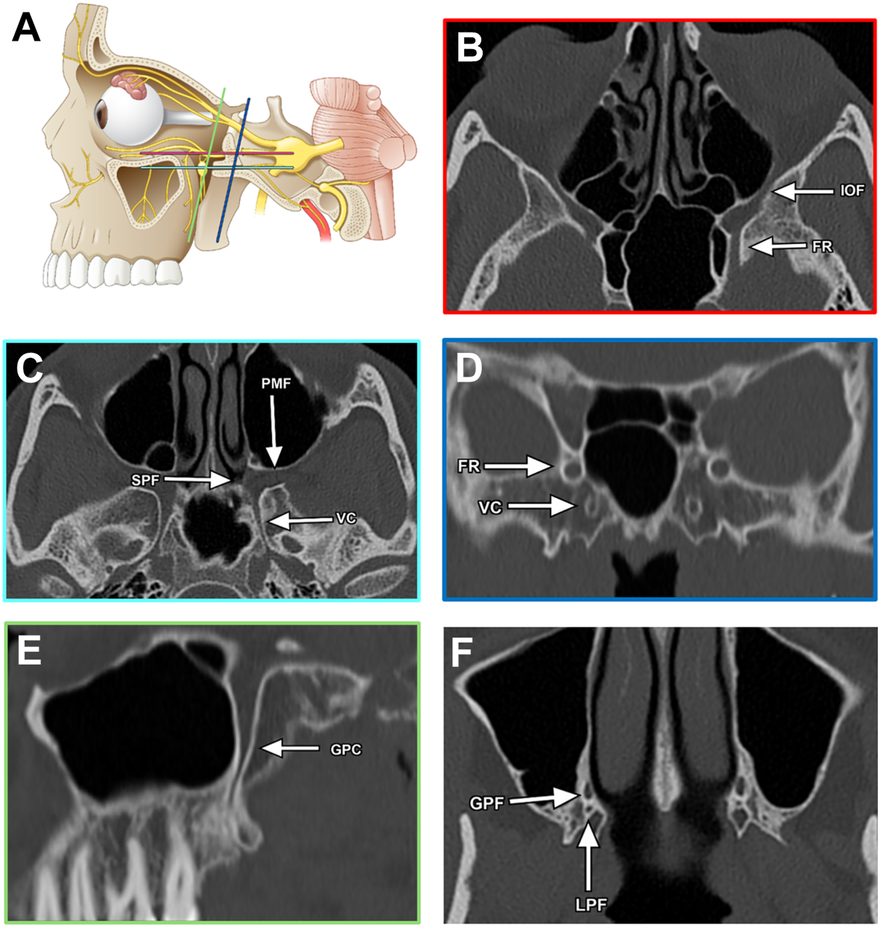 A set of six panels presents an anatomical diagram of the eye and nerves, along with five C T scans of the sinuses and orbit, each with arrows and abbreviations marking specific structures.