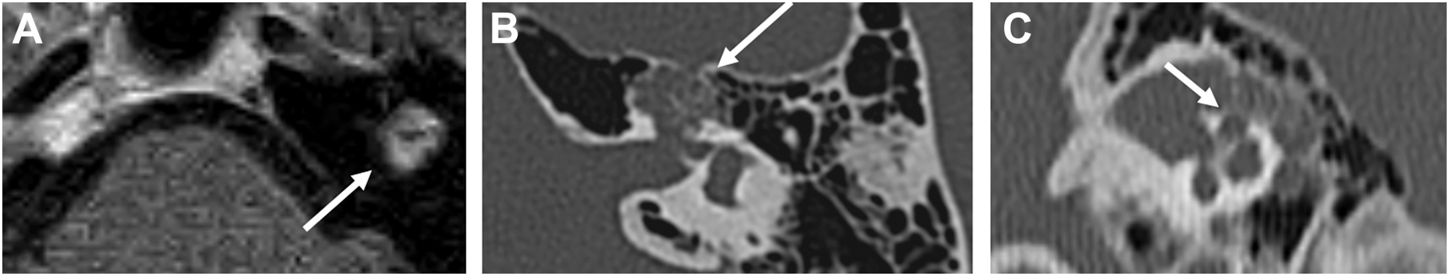 A set of three computed tomography and magnetic resonance scans show a localized lesion along the temporal bone with bony and soft tissue changes.