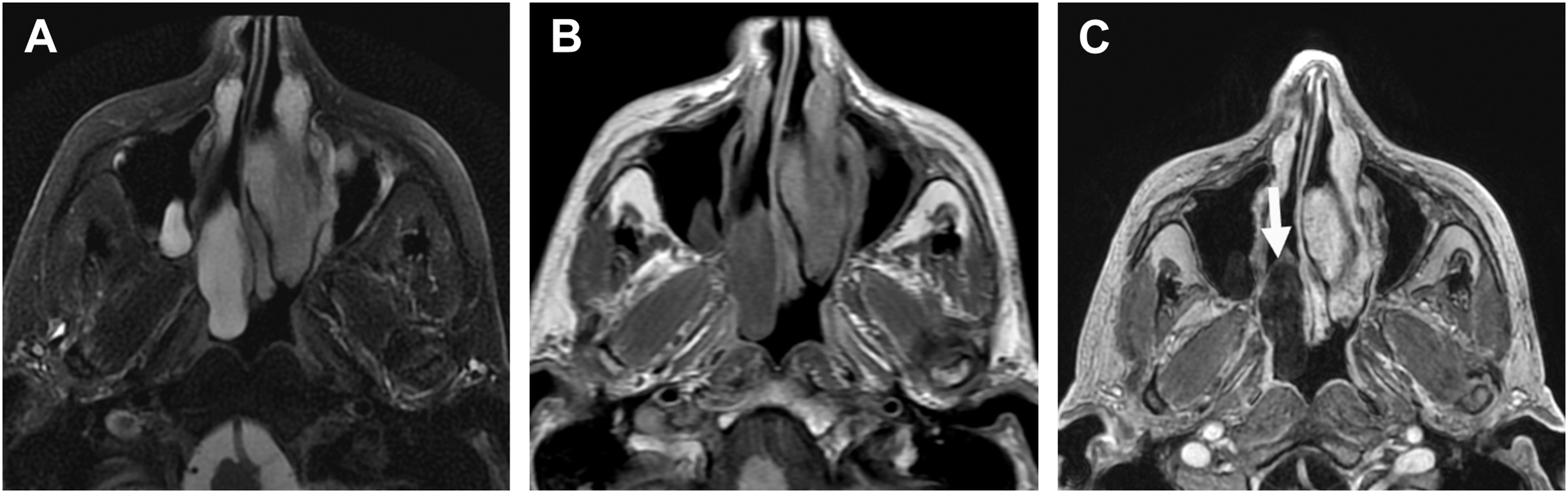 An axial sequence of three MRI scans depicts a soft tissue mass in the right nasal cavity with arrow showing lack of central enhancement.