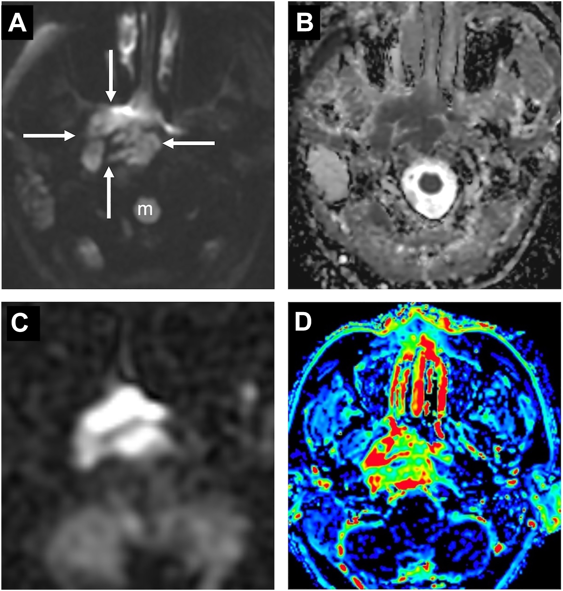 A set of four axial M R I scans of the head with arrows and labeling in part A, illustrating a mass and surrounding anatomical features, including a marked region labeled m.