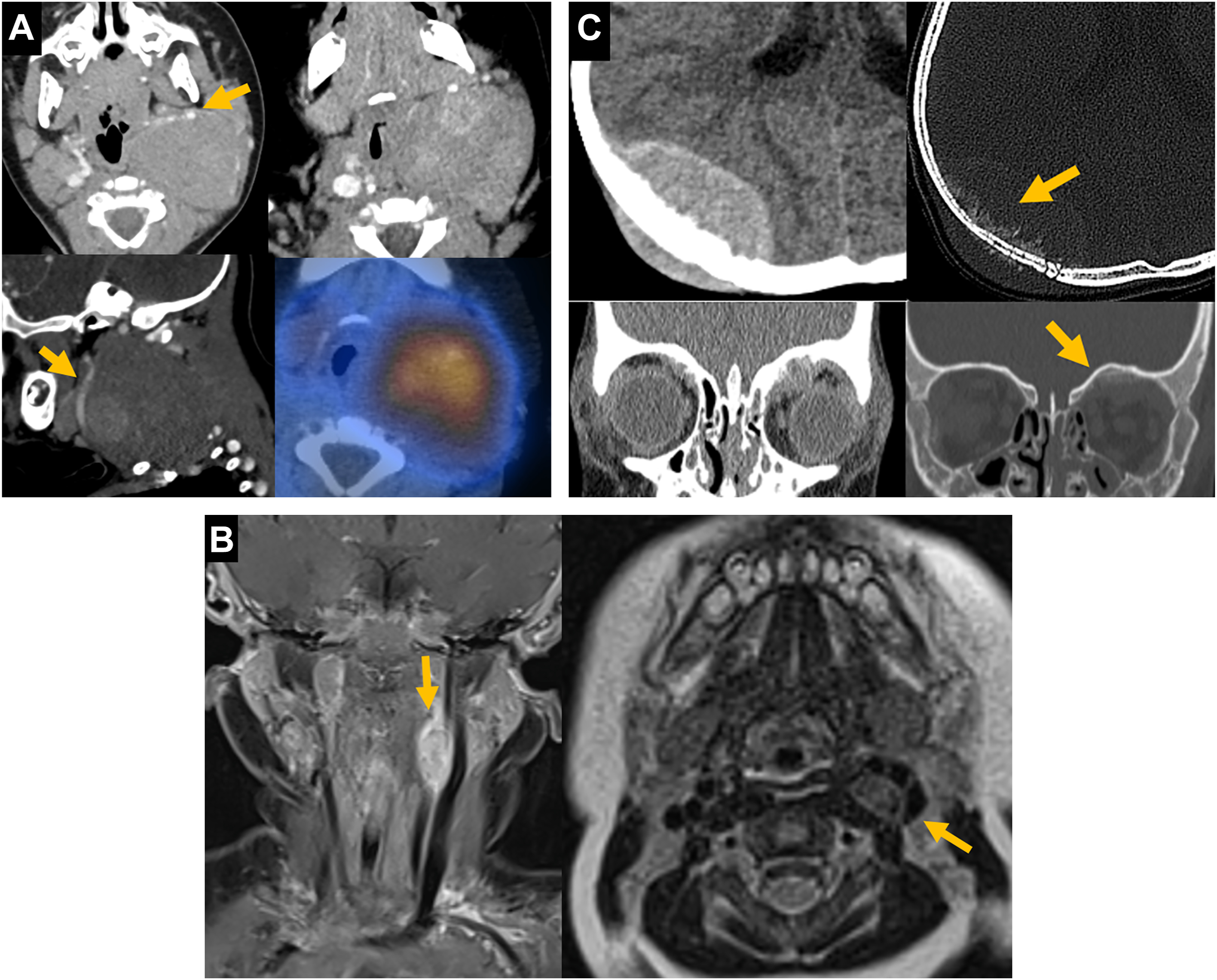 A collage of C T, M R I, and P E T scans across the head and neck regions with arrows marking lesions or abnormalities in multiple anatomical locations.