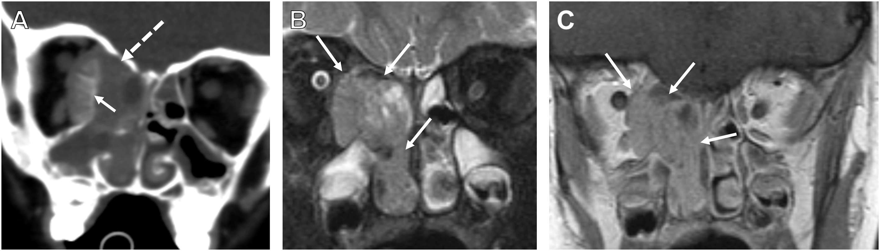 Three coronal radiological scans show a tumor in the right sinonasal cavity with orbital extension.