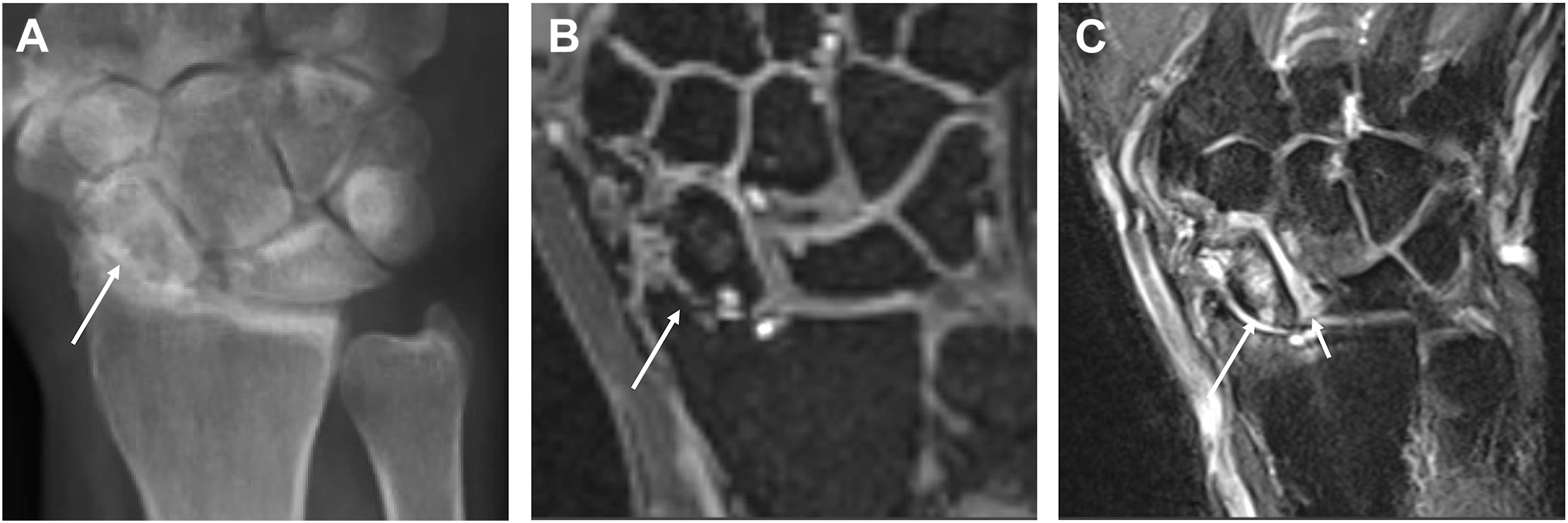 A set of three scans, A, B, and C, shows osteoarthritis in a wrist. Panel A is a radiograph, and panels B and C are m r i scans showing a scapholunate tear.