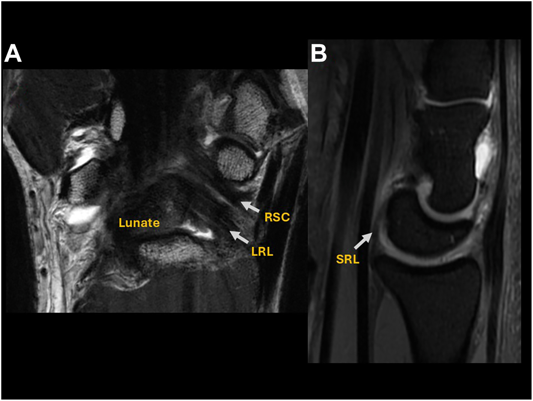 Two M R I scans of the human wrist show the extrinsic ligaments, such as the radioscaphocapitate, long radiolunate, and the short radiolunate ligaments.
