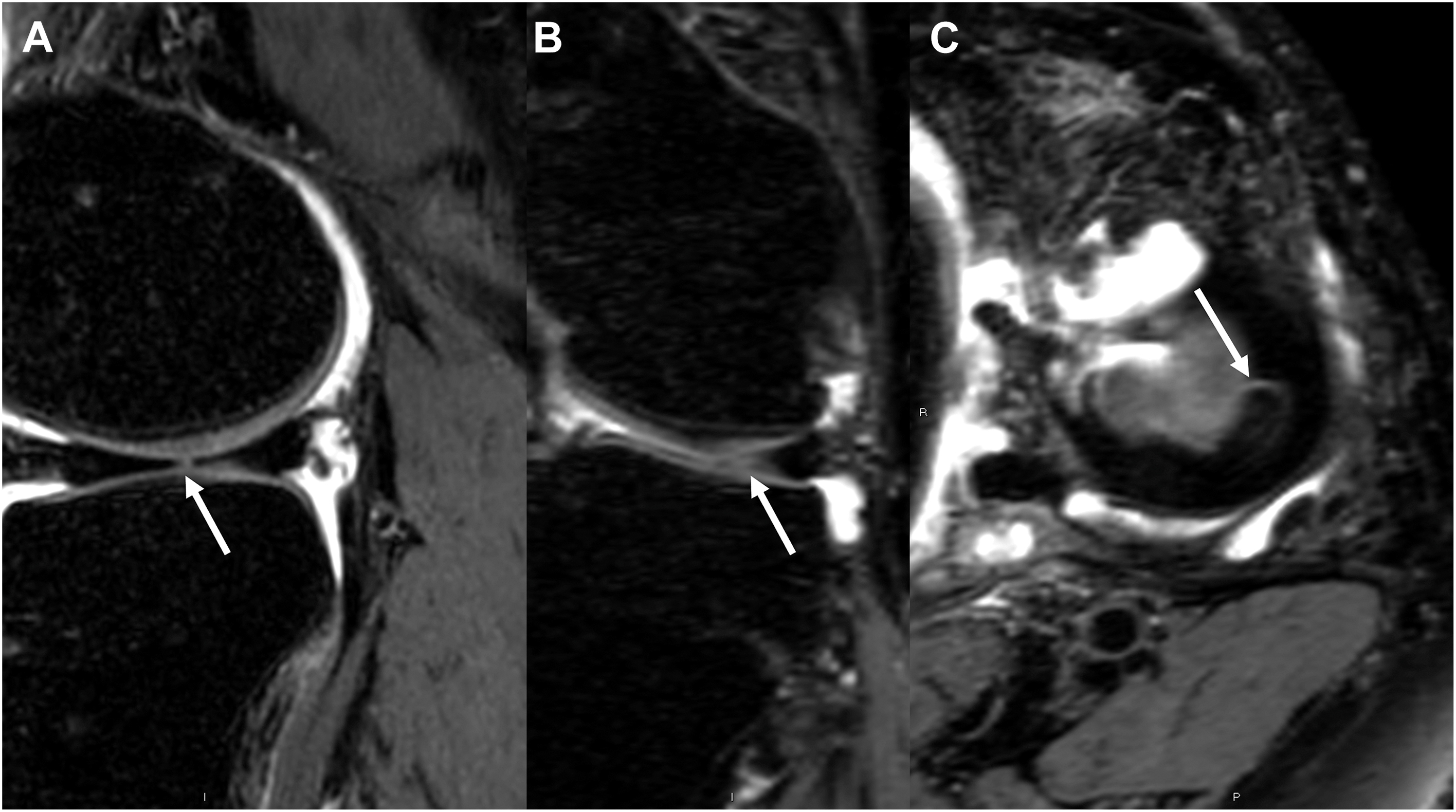 A three-panel 3 D M R I shows a small radial tear of the lateral meniscus mid-body. Panel A is a sagittal view, panel B is a coronal view, and panel C is an axial view, with arrows marking the tear.