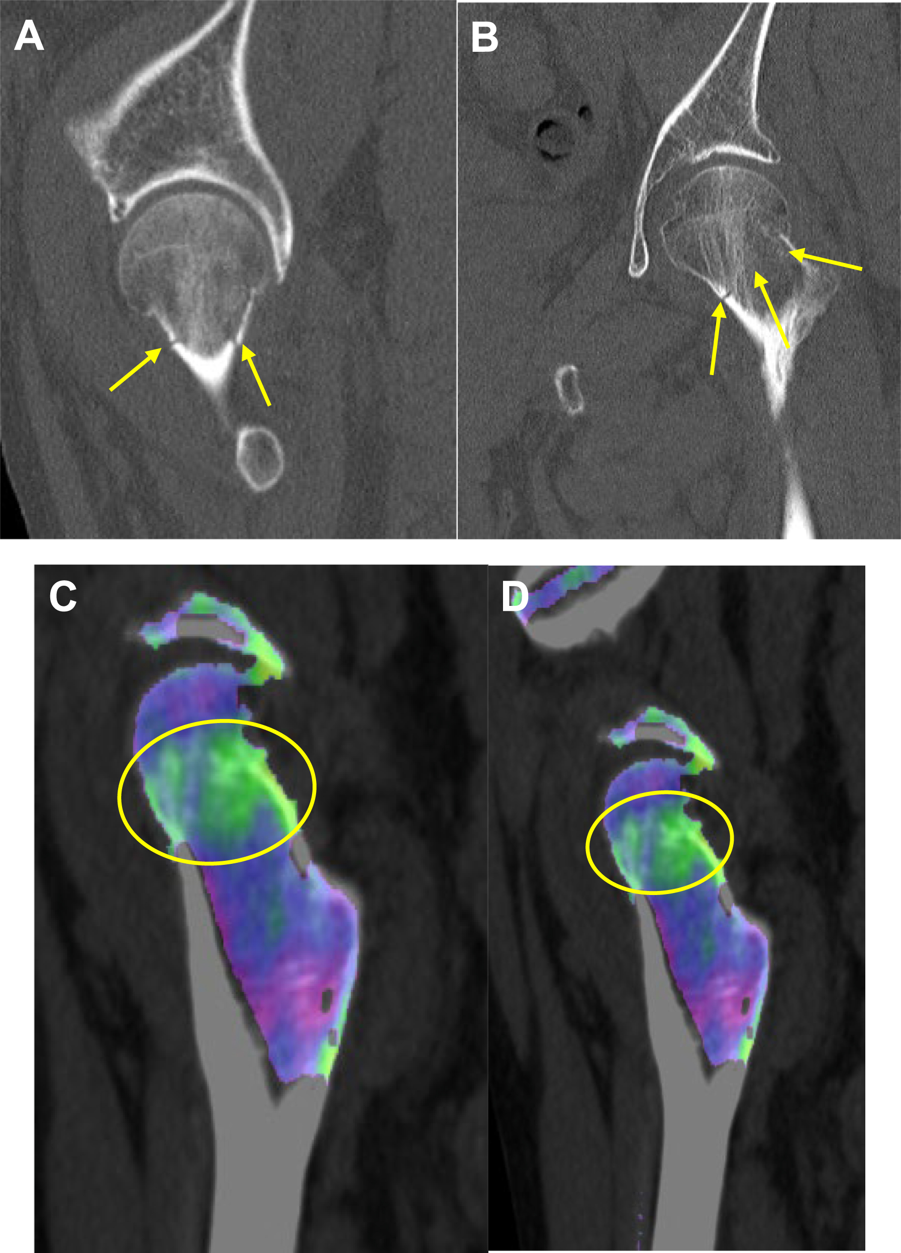 Four hip images labeled A, B, C, and D showing an acute femoral neck fracture.