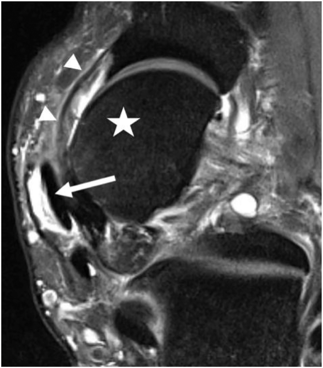 An axial M R I scan of an ankle shows tenosynovitis. A star marks the talus, arrowheads mark the spring ligament, and a long arrow points to the P T T.