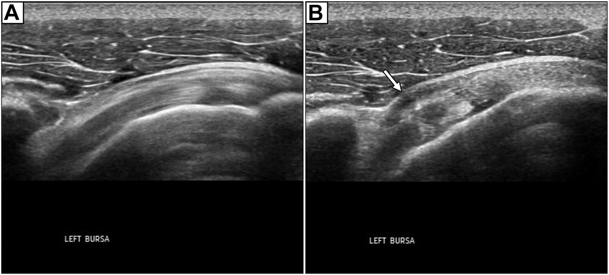 A two-panel ultrasound scan, a and b, of the left bursa, shows no thickening in the neutral position but bunching of the subacromial subdeltoid bursa on abduction.