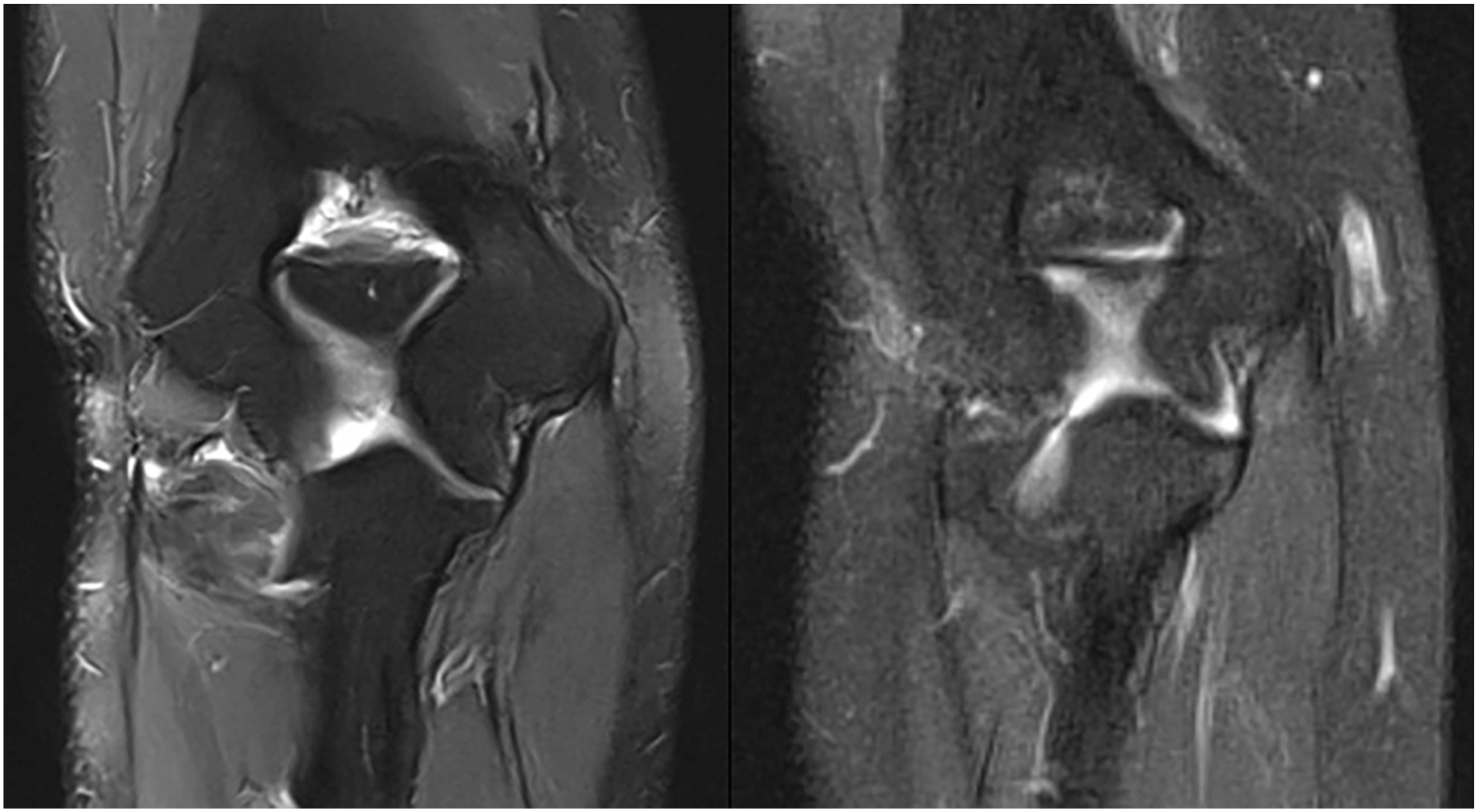 An M R I scan shows two coronal sections of the elbow joint side by side, displaying the joint space, humeral bone, ulna, and surrounding soft tissue.