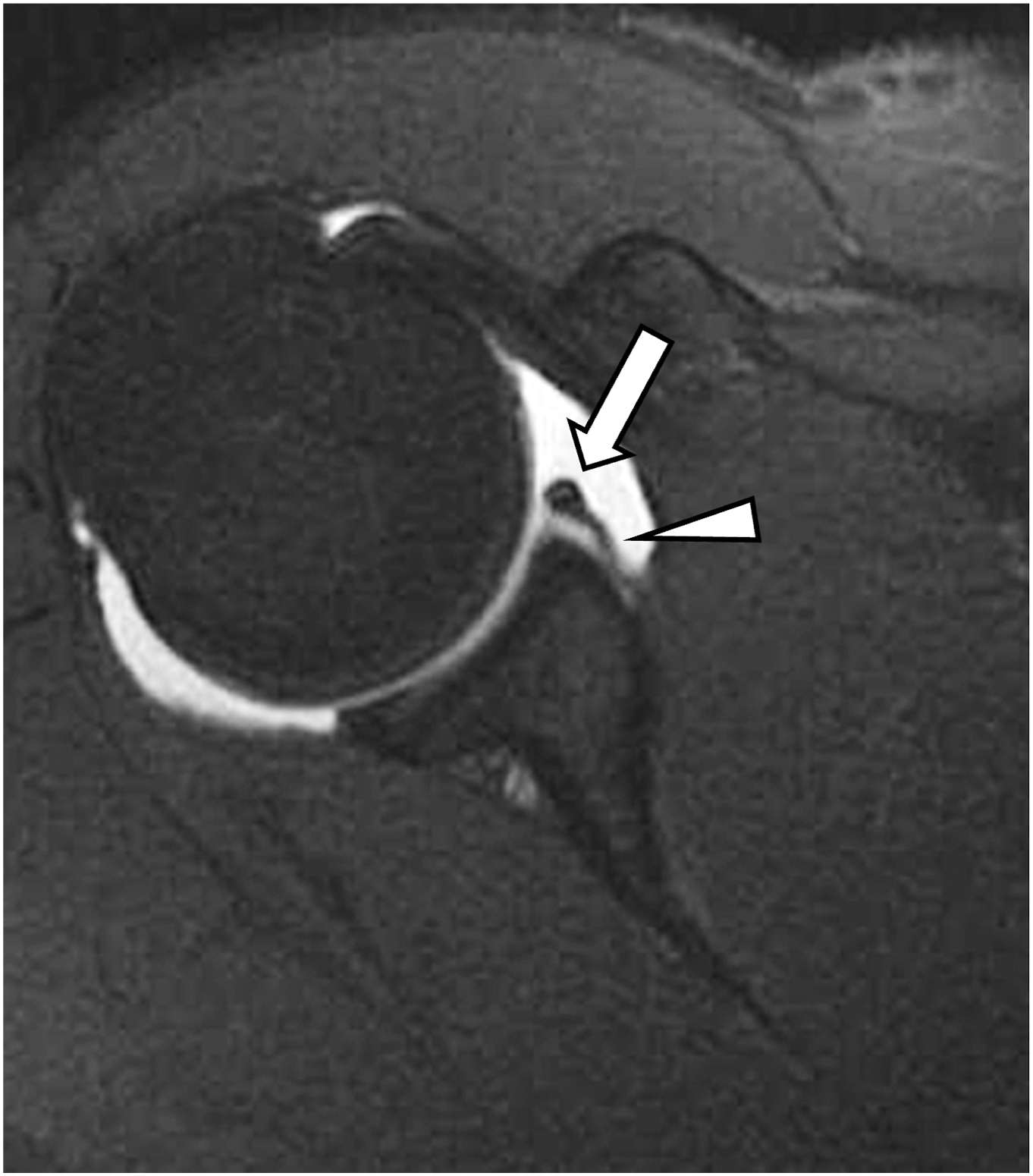 An axial shoulder M R scan shows a lower rim tear of the joint lining with tissue lifted but still attached to the surrounding layer.