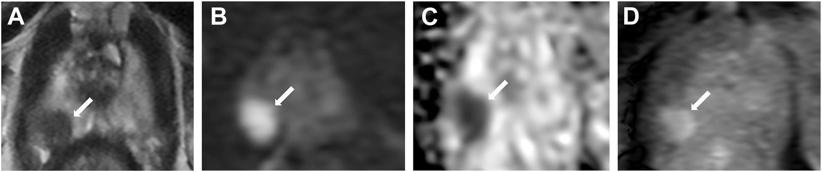 A four-panel M R I of a 75-year-old male prostate shows a 1.6 by 0.3 centimeter malignant lesion in the right peripheral zone, indicated by arrows across different imaging sequences.
