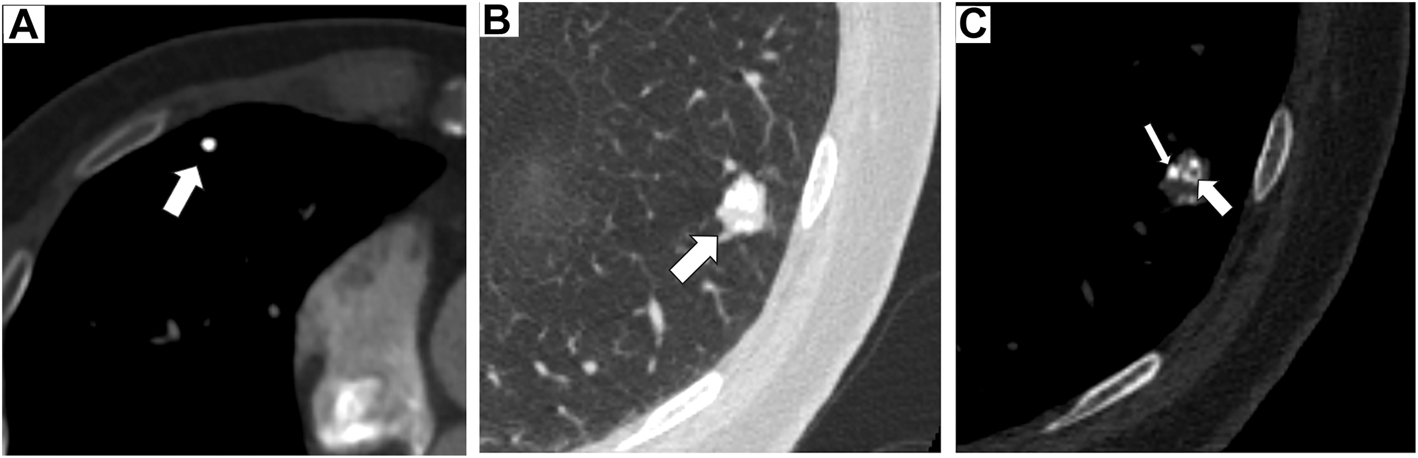 Three C T scans show Lung-R A D S category 1, which highlights a benign calcified granuloma and a pulmonary hamartoma with internal fat and calcium.