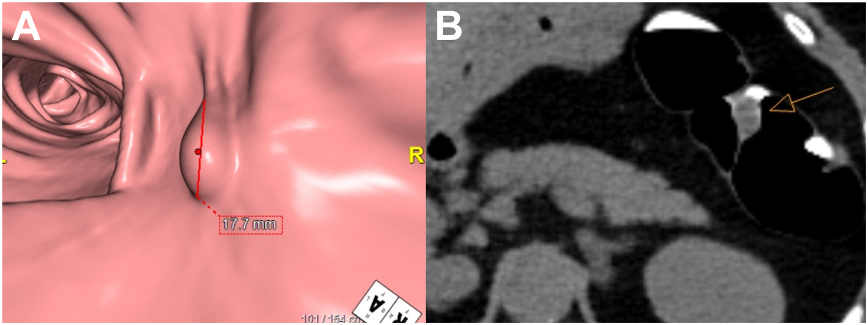 Two panels show an 18 millimeter splenic flexure polyp in a 64-year-old female, visualized via 3 D endoluminal and 2 D axial C T images during a colonography.