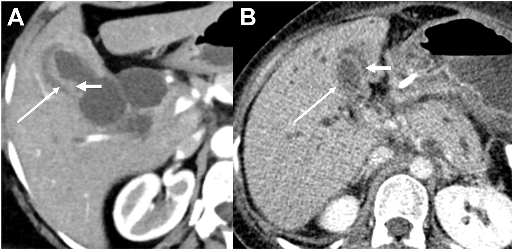 A two-panel axial computed tomography shows malignant gallbladder wall thickening with layered enhancement, including a thin enhancing inner layer and heterogeneous mural enhancement.