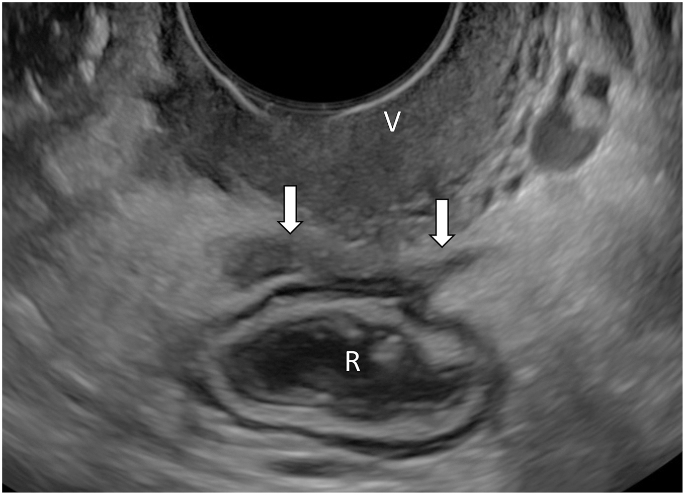 A sagittal transvaginal ultrasound shows a bilobed hypoechoic soft-tissue lesion in the rectovaginal septum between the rectum and vagina, consistent with deep endometriosis.