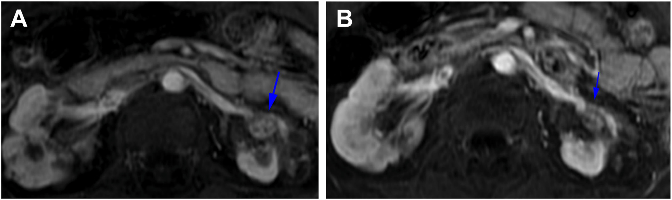 Two axial T 1-weighted M R shows a left kidney mass and a significant decrease in mass size after two years of belzutifan therapy for a patient with V H L disease.