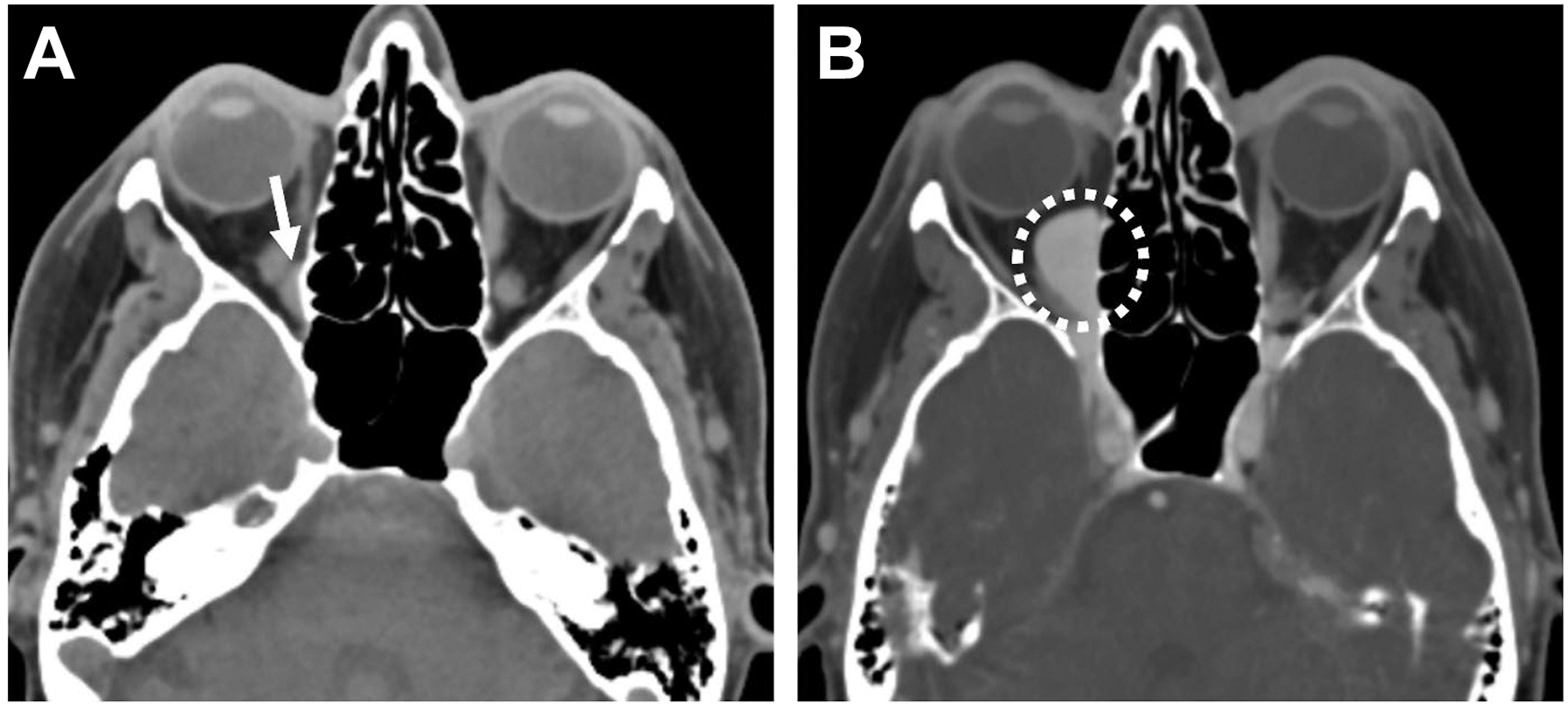A two-panel axial computed tomography scan compares a resting state orbit to a Valsalva maneuver state, demonstrating the size increase of a mass behind the right eye.