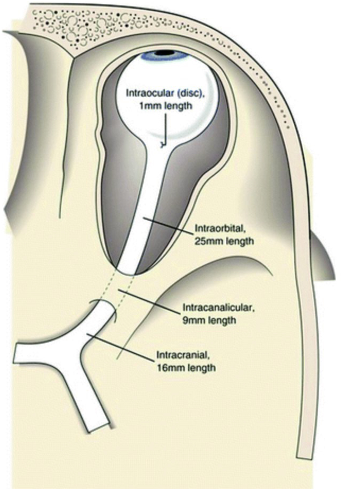 A diagram of optic nerve anatomy and its four labeled segments with their respective lengths within the orbit and skull.