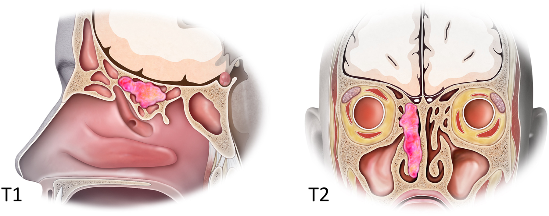 A labeled anatomical diagram shows T 1 and T 2 stage tumors in the ethmoid sinus and nasal cavity.