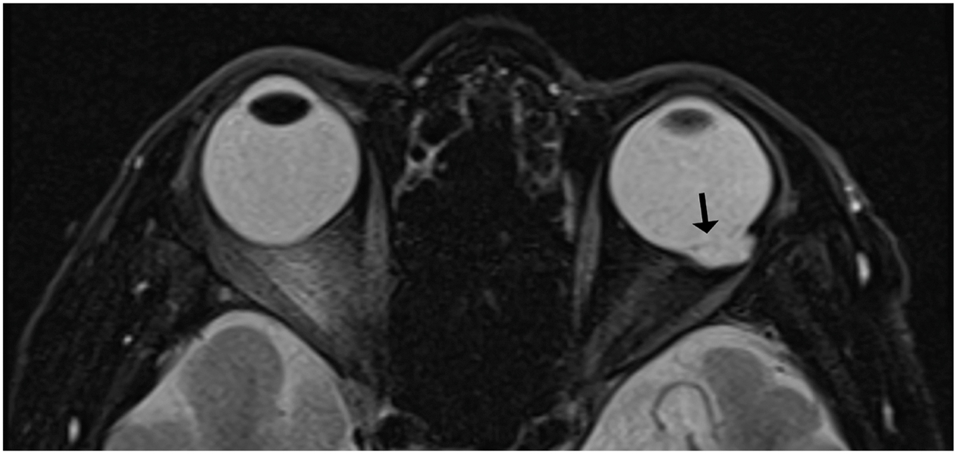 An axial T2-weighted M R I shows left microphthalmia with posterior globe defect, vitreous humour herniation, and retrobulbar cyst (arrow).
