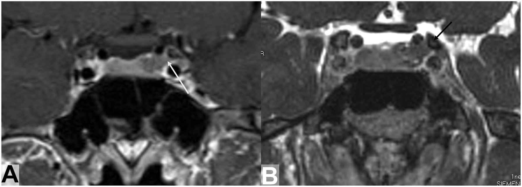 A two-panel coronal T 1-weighted and C I S S scans show a small left pituitary adenoma extending to the intercarotid line and abutting the anterior clinoid process, indicating grade 3 a disease.