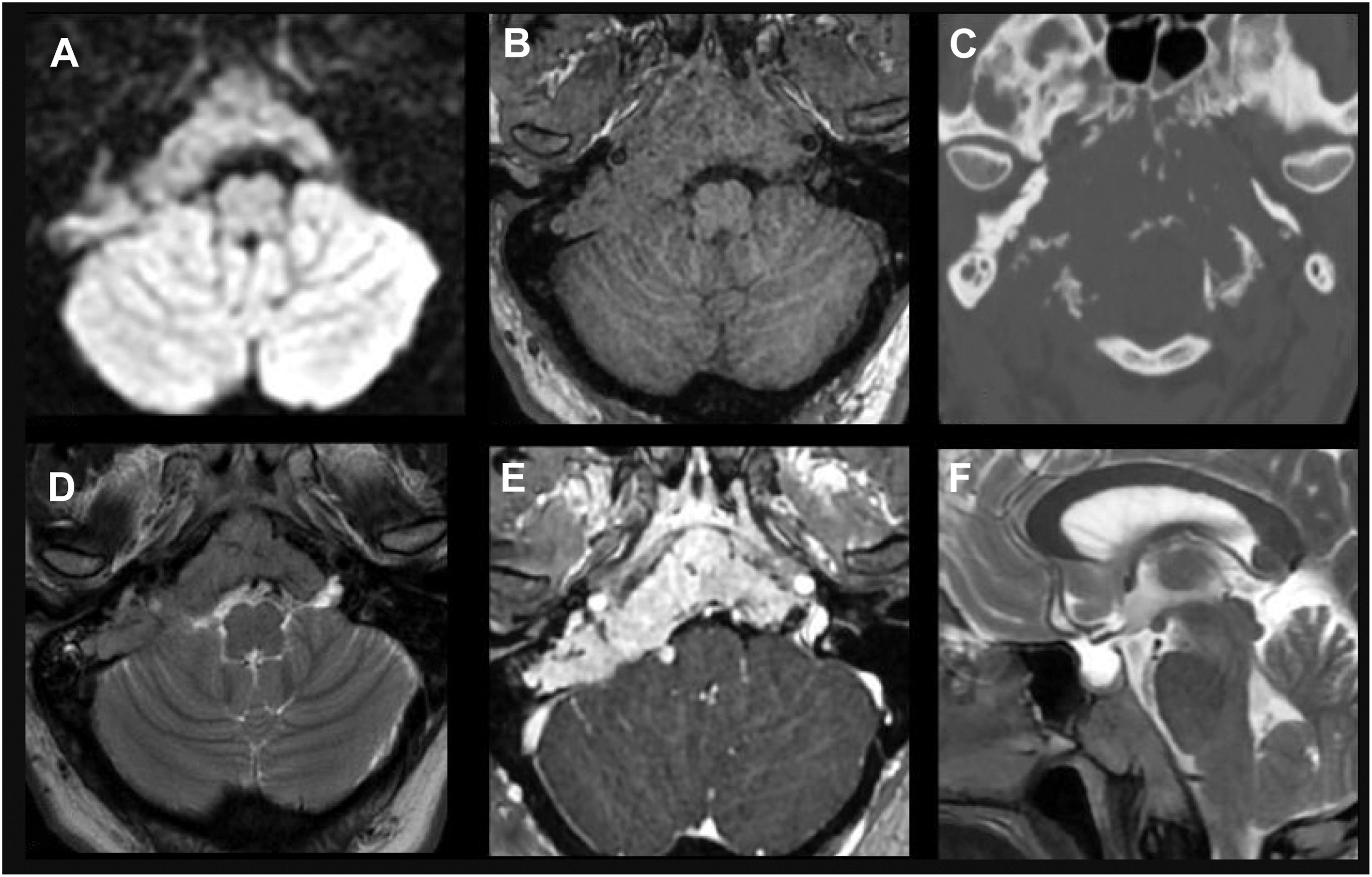 A six-panel multimodal radiological scan of a clival plasmacytoma shows reduced diffusivity, osseous destruction, expansile behavior, intermediate T 2 signal, and avid contrast enhancement.