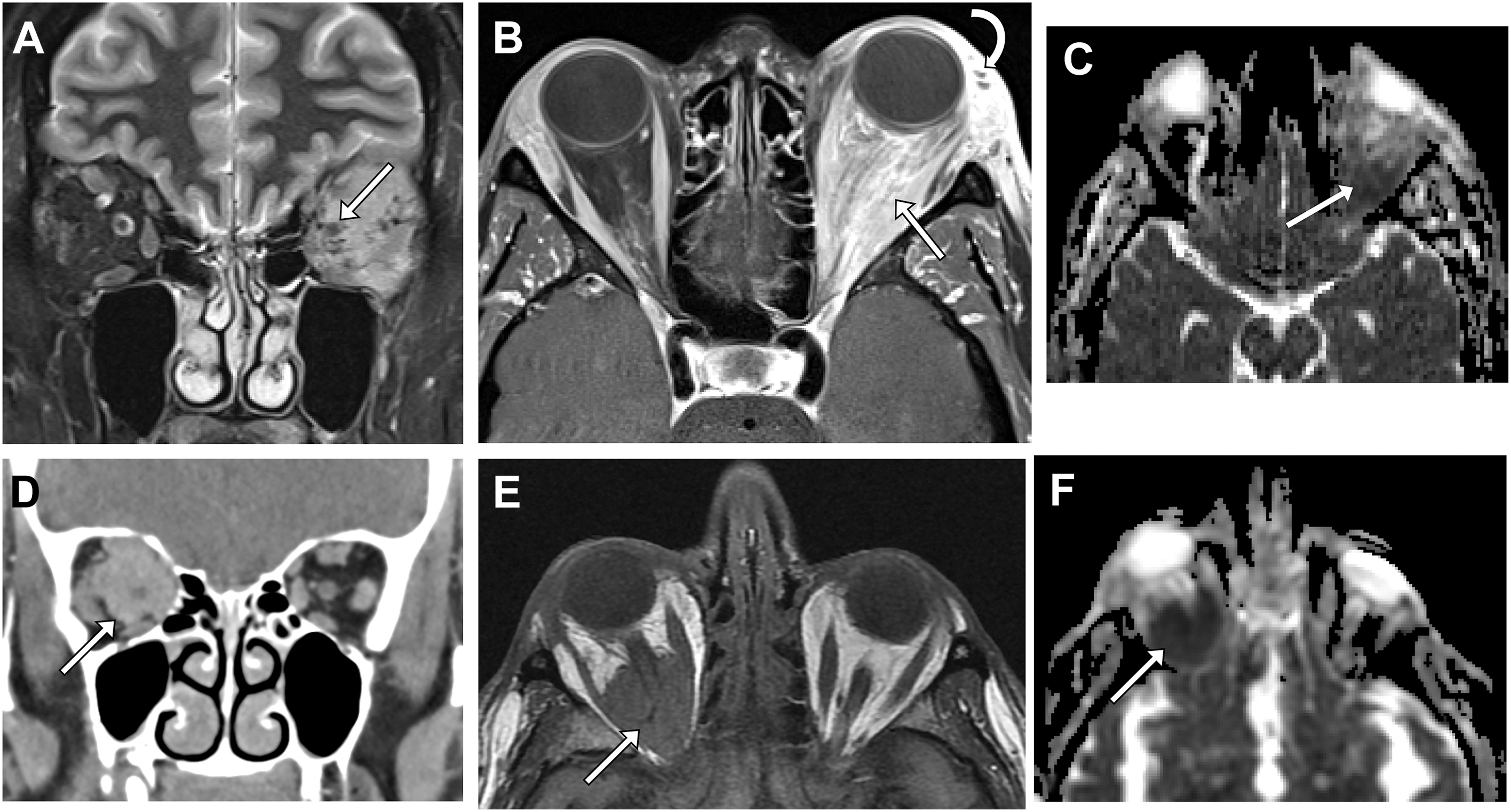 A set of six radiological scans from two patients shows intraconal lymphoma with intermediate hyperintense signals, infiltrating enhancement, restricted diffusion, and uniform soft tissue masses.