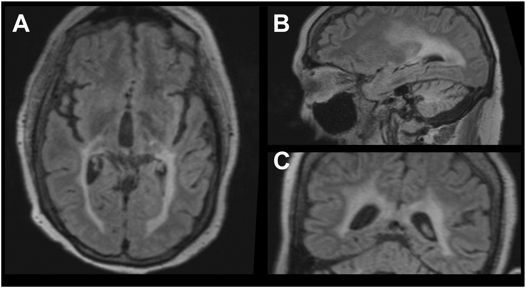 A three-panel fluid attenuated inversion recovery magnetic resonance imaging scan shows axial, sagittal, and coronal views of a brain with adrenoleukodystrophy involving the optic radiations.