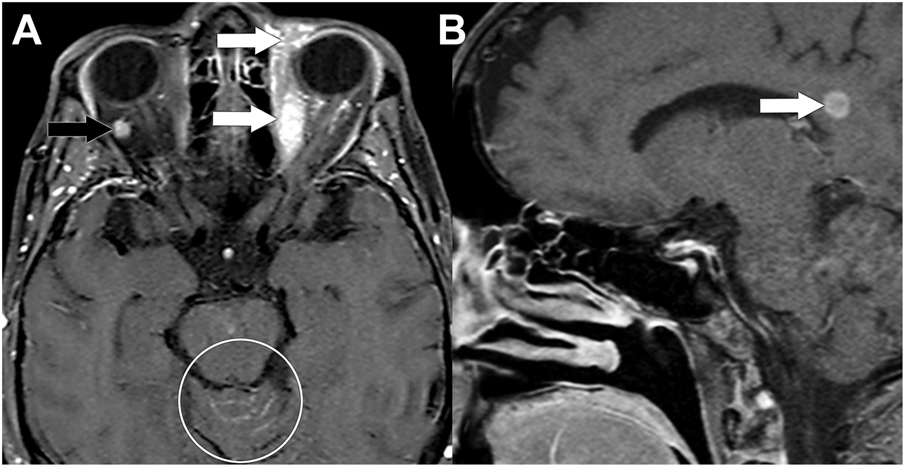 A two-part magnetic resonance imaging scan shows the metastatic breast carcinoma with leptomeningeal disease, highlighting orbital and intracranial metastases using arrows and a distinct circle.