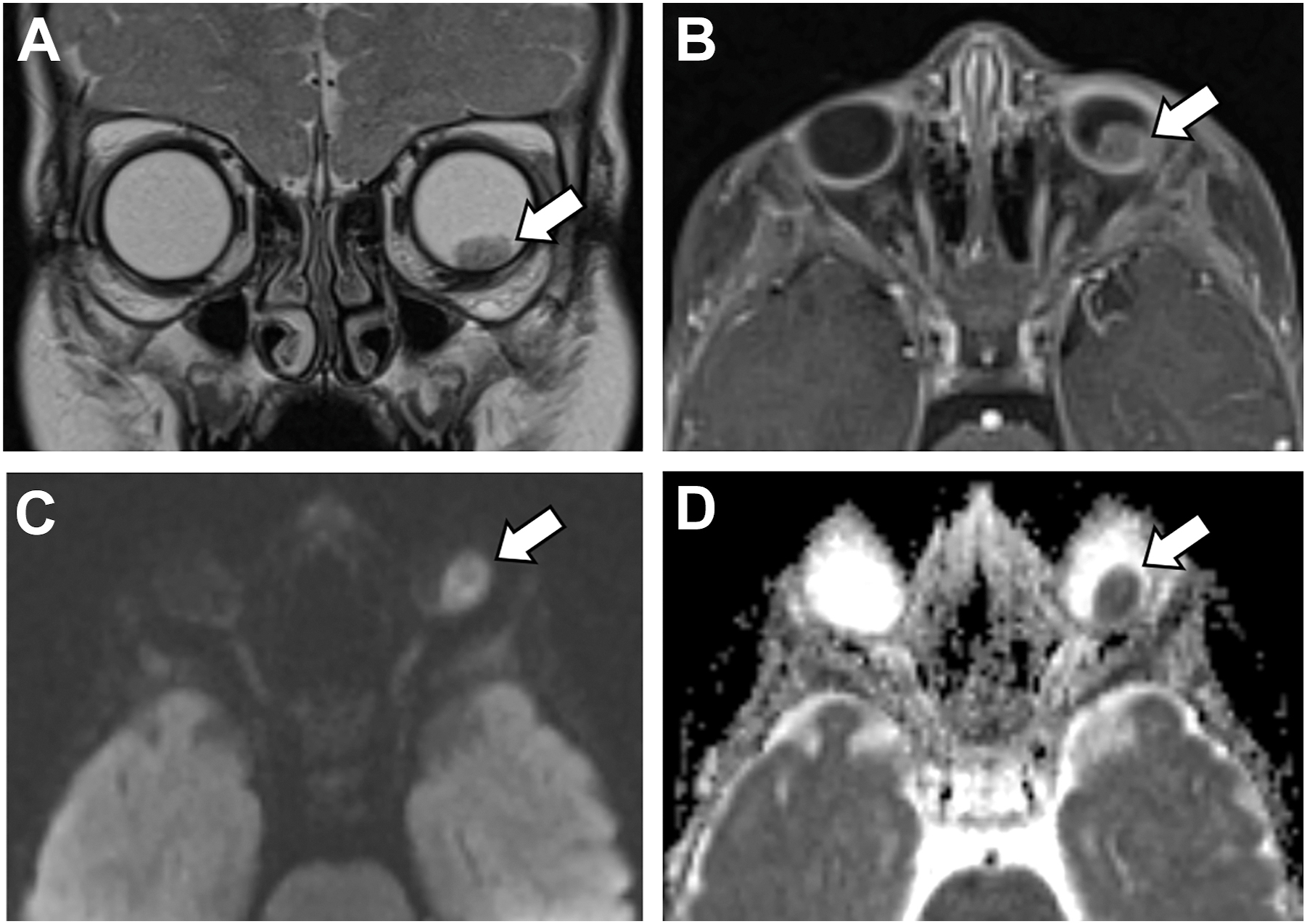 Four M R I scans of a 1-year-old child's eye, revealing a tumor, are labeled A through D.