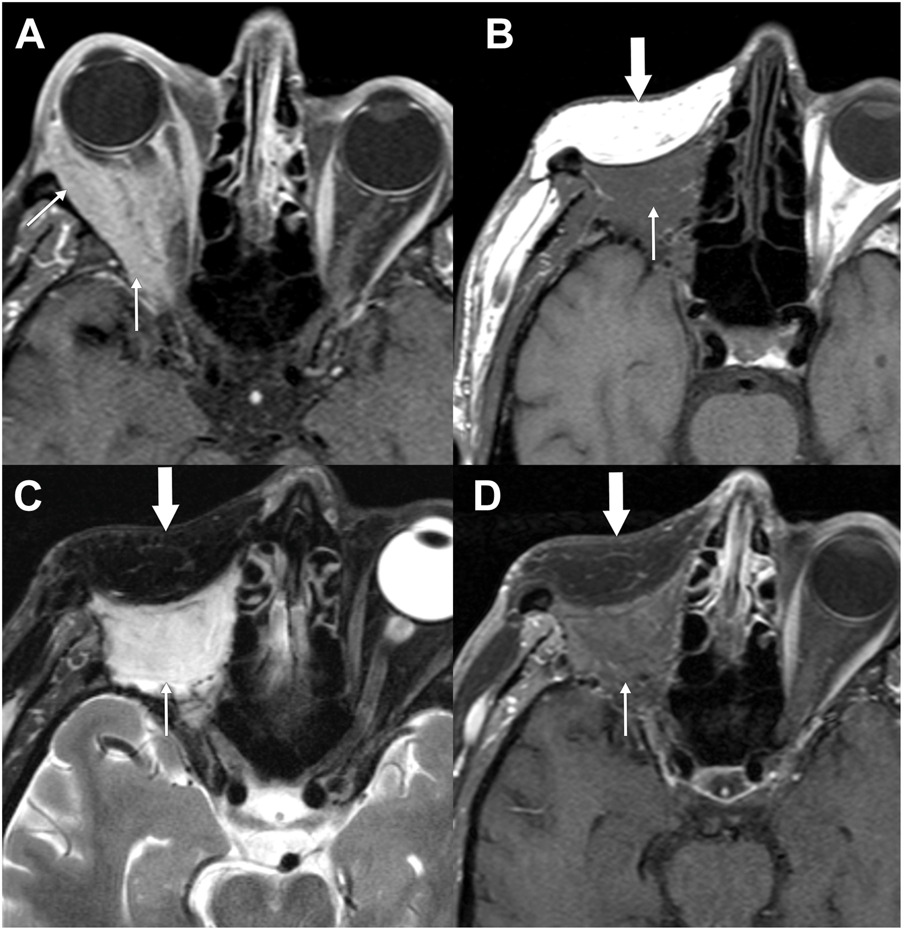 A set of four magnetic resonance imaging scans shows an infiltrative right orbital mass before surgery and the appearance of a myocutaneous flap with fat and muscle components after exenteration.