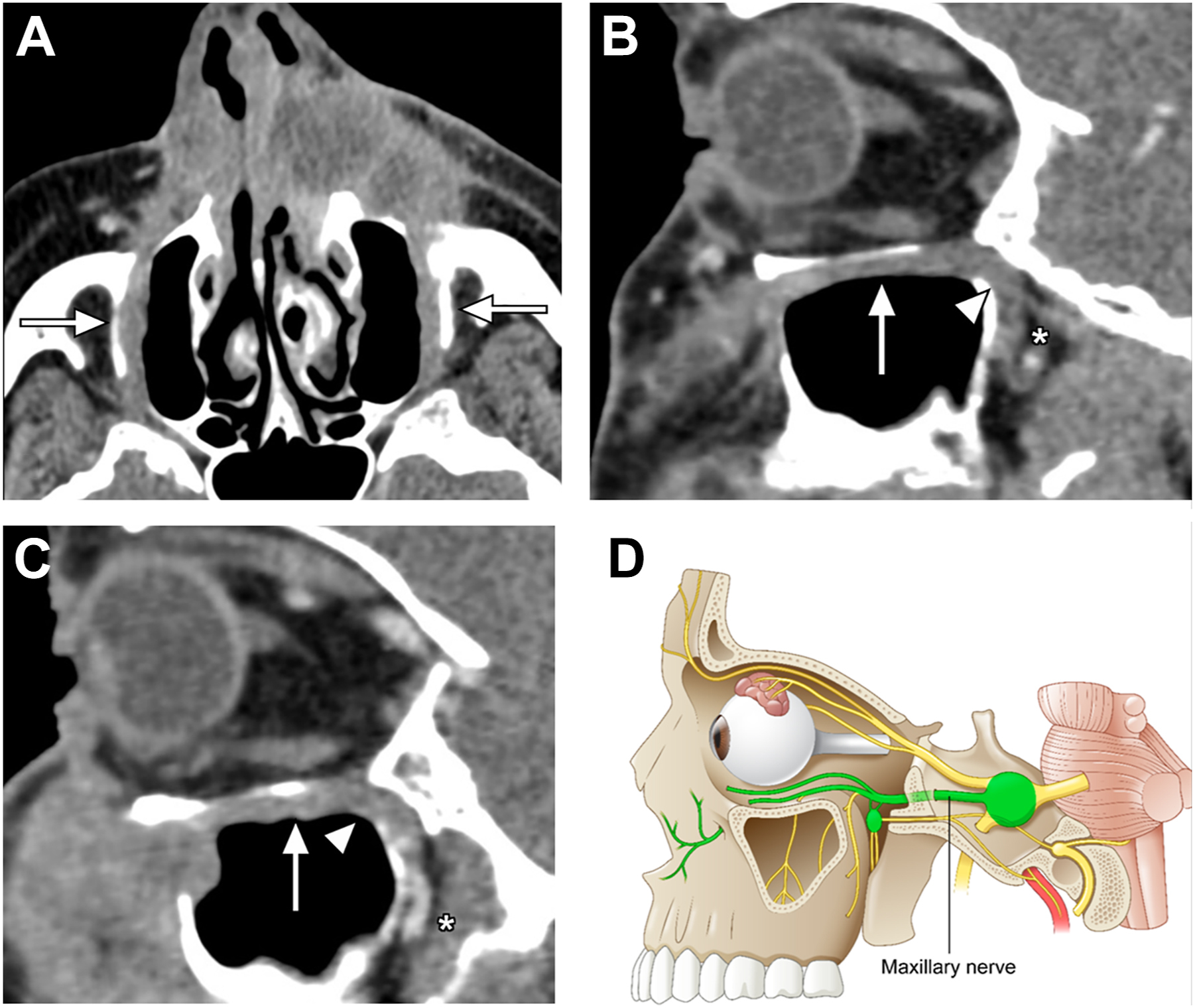 A series of C T scans and an anatomical diagram shows orbital floor fractures with herniation of soft tissue into the maxillary sinus, marked by arrows.