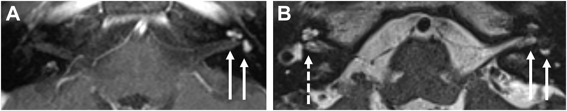 Two axial magnetic resonance scans showing bilateral enhancing lesions near the cranial nerve pathways, with arrows indicating abnormal regions.