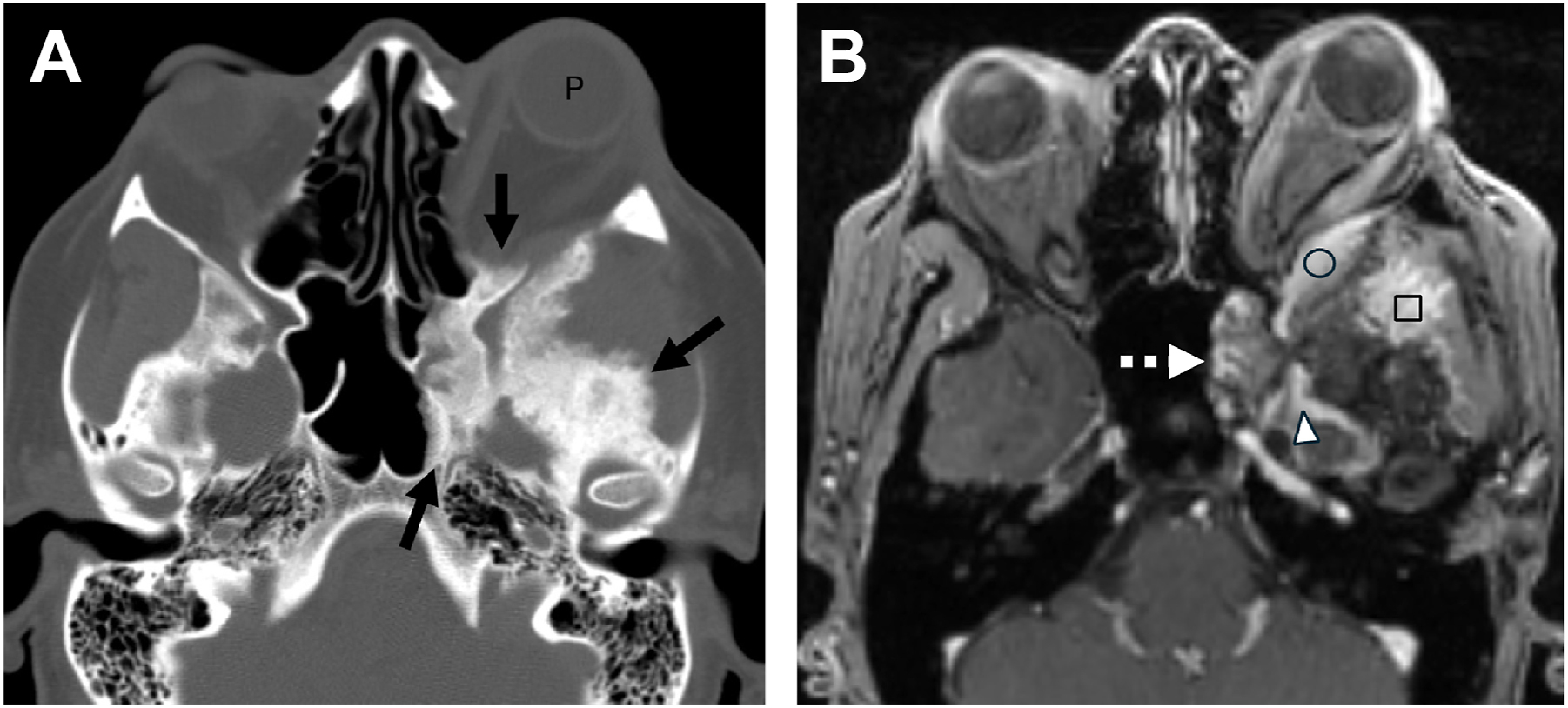 A coronal C T and M R I scan in panels A and B, with arrows and symbols, includes a circle, square, triangle, and arrowhead marking distinct regions and a label P.