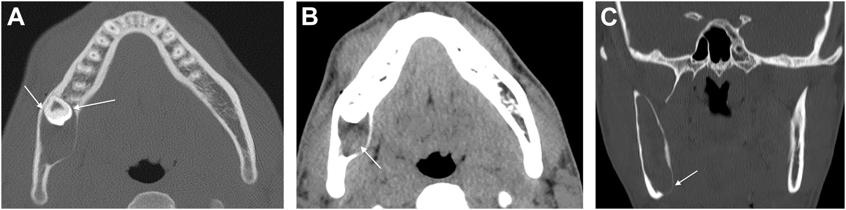 Three computed tomography views show a mandibular lesion with confirmed odontogenic keratocyst pathology around an unerupted third molar.