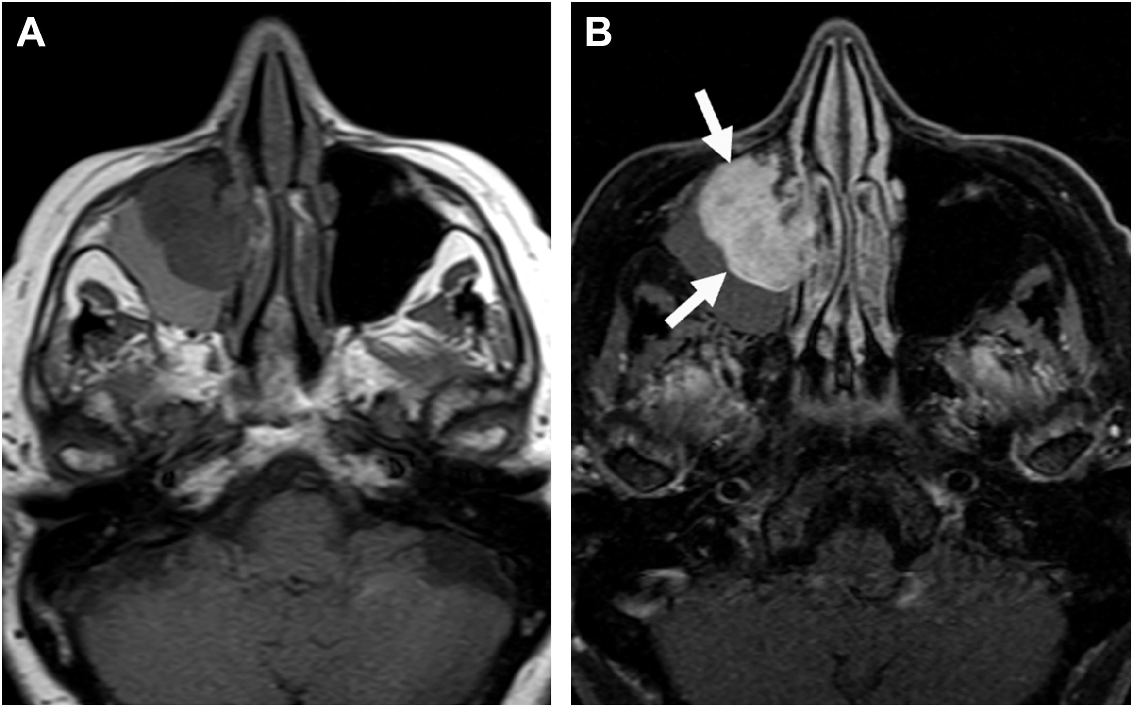 An axial MRI pair depicts a right maxillary sinus mass more clearly enhanced on the right scan, with two arrows indicating its margins and extension into the surrounding regions.