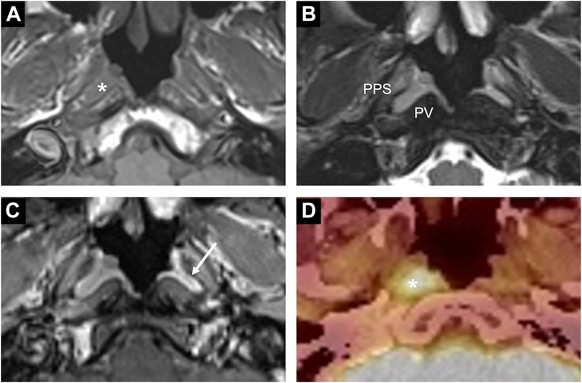 An M R I and P E T or C T panel labeled A to D showing axial views of a nasopharyngeal mass marked by asterisks and an arrow, with adjacent structures labeled P P S and P V.
