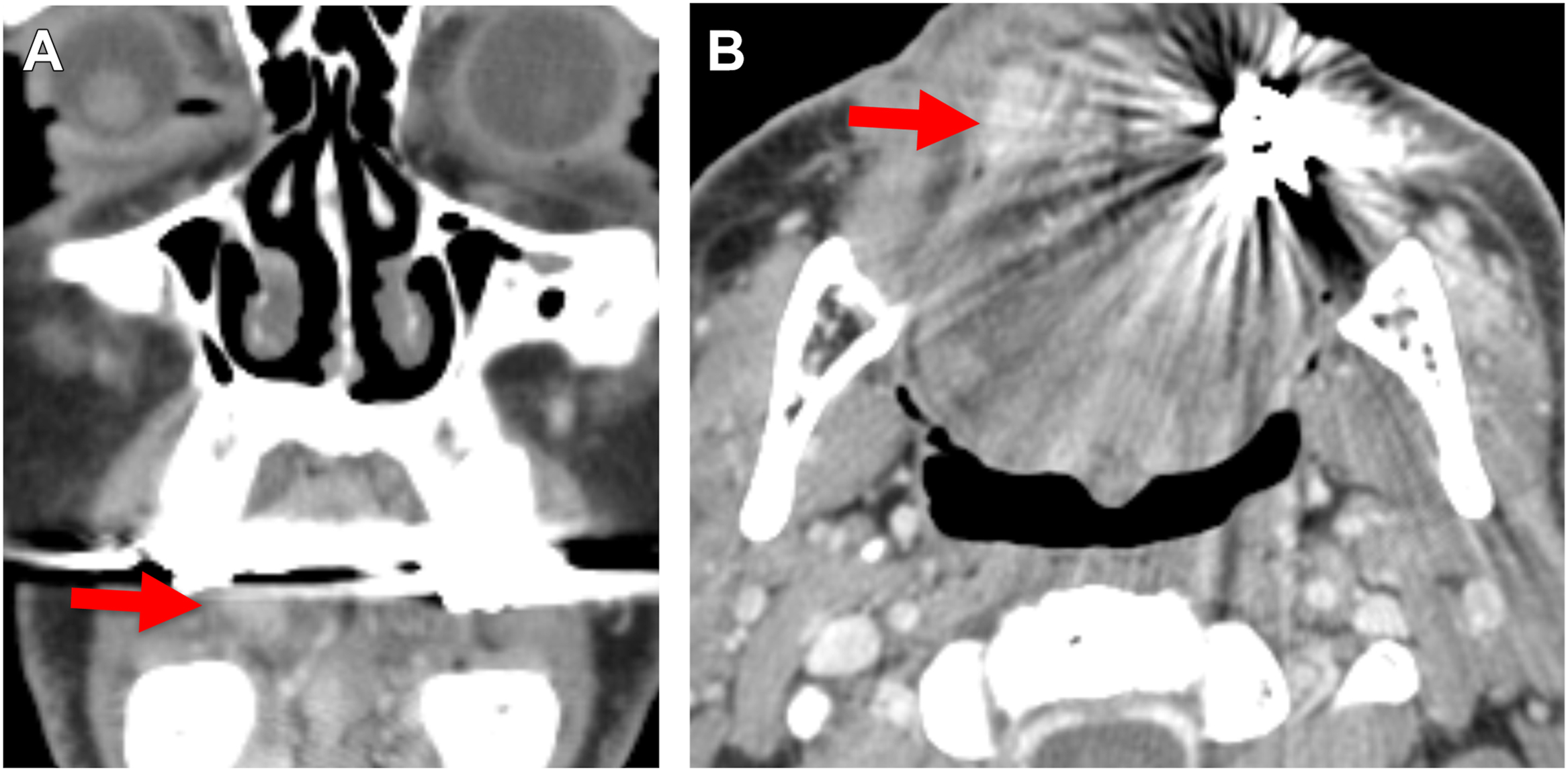 A coronal and axial post-contrast C T scan depicts right lateral tongue S C C with tumor thickness of 8 millimeters on coronal view and 2 millimeters depth of invasion on pathology.