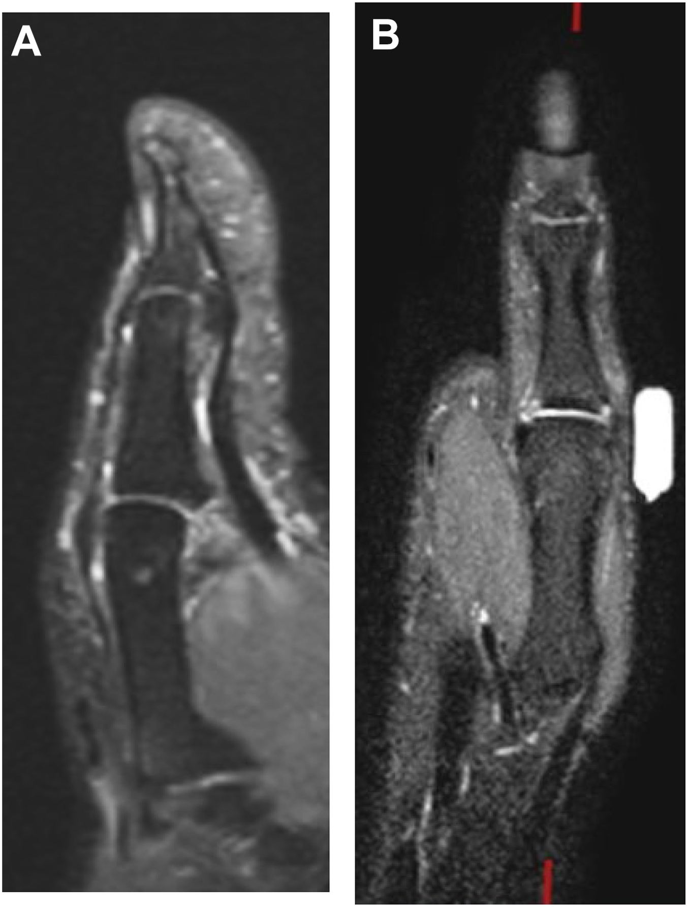 A set of two M R I scans shows ligamentous injuries in a hand. Panel A is a sagittal view showing a volar plate tear, and panel B is a coronal view showing an ulnar collateral ligament tear.
