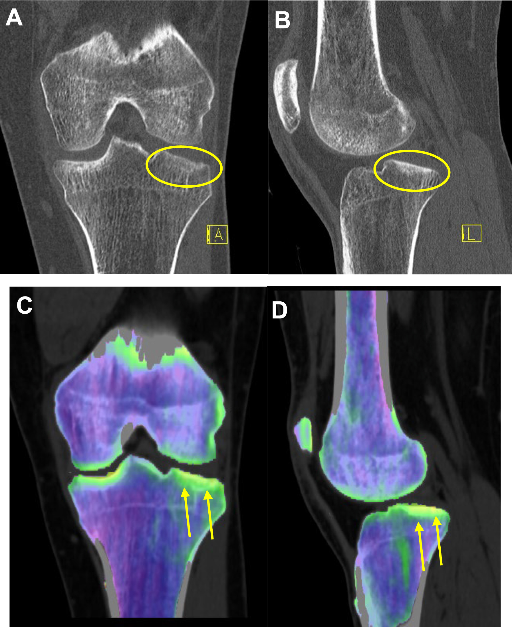 Four CT images showing a lateral tibial plateau fracture.