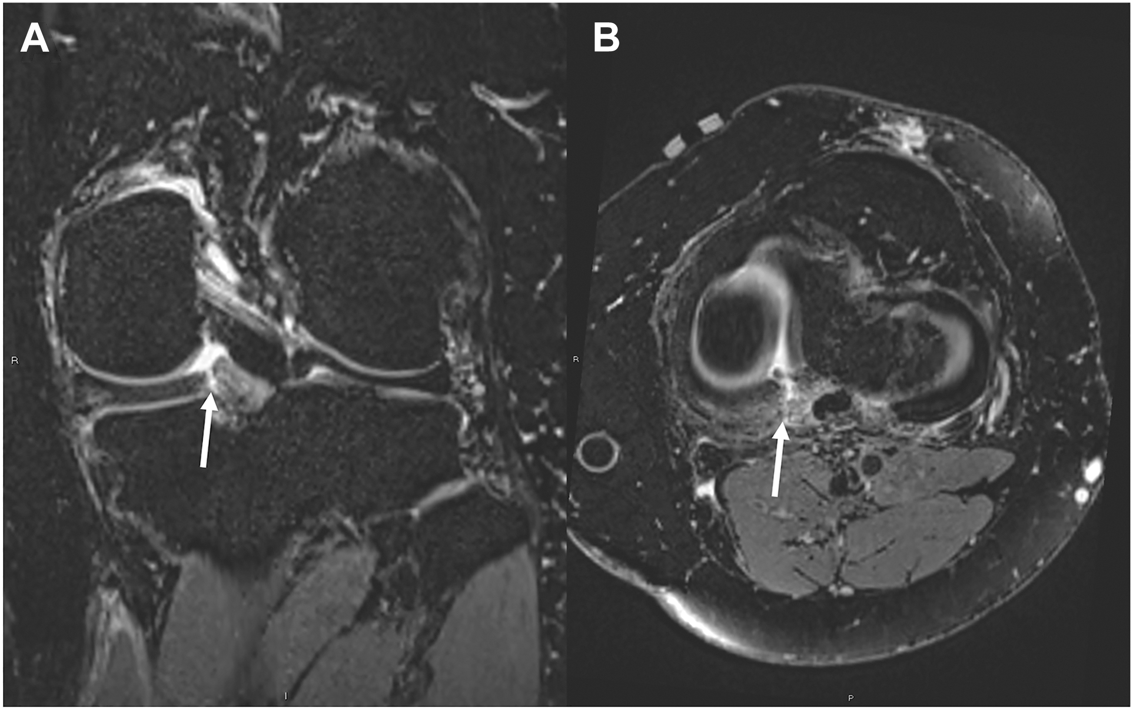 A two-panel 3 D M R I of a left knee shows a complete radial tear of the medial meniscus posterior root attachment. Panel A is a coronal view, and panel B is an axial view.