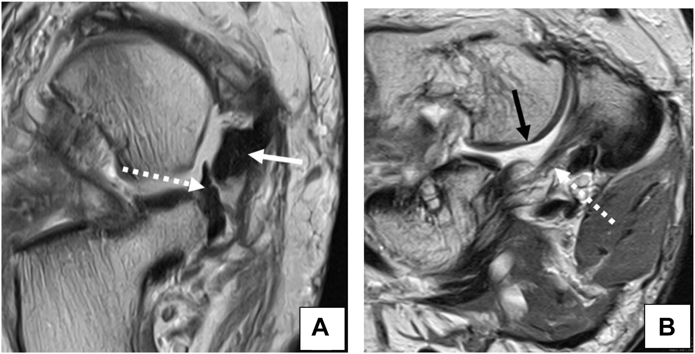 A set of two M R I scans, And B, shows a P T T tear with spring ligament rupture. The axial and coronal P D views use arrows to mark the torn P T T, ruptured ligament, and cartilage loss.