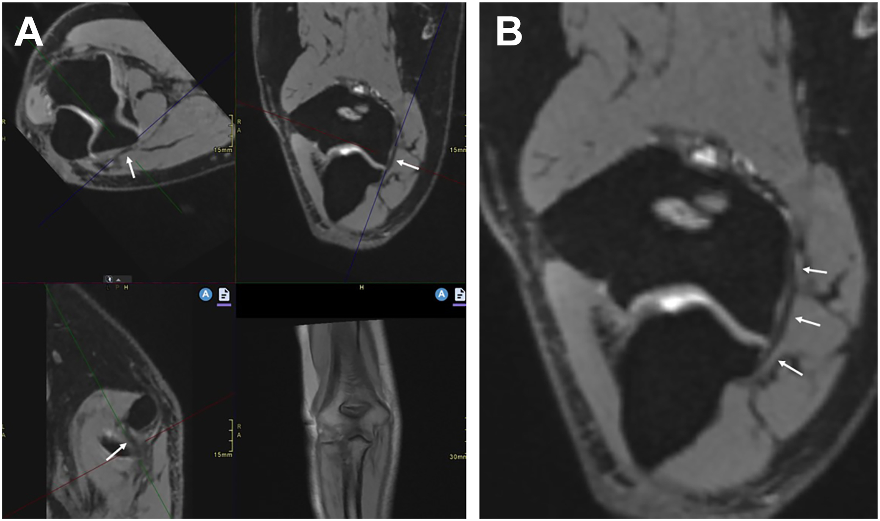 Two M R I scan shows reformatted views of the elbow joint with arrows marking the ligament, and an enlarged view highlights the ligament with three arrows.